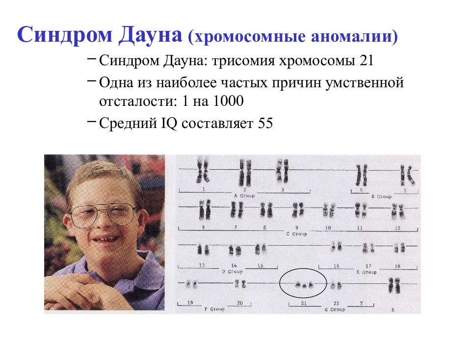 Синдром дауна лишняя хромосома. Синдром Дауна хромосомы. Синдром Дауна трисомия 21 хромосомы. Синдром Дауна трисомия 21. Синдром Дауна хромосомная патология.