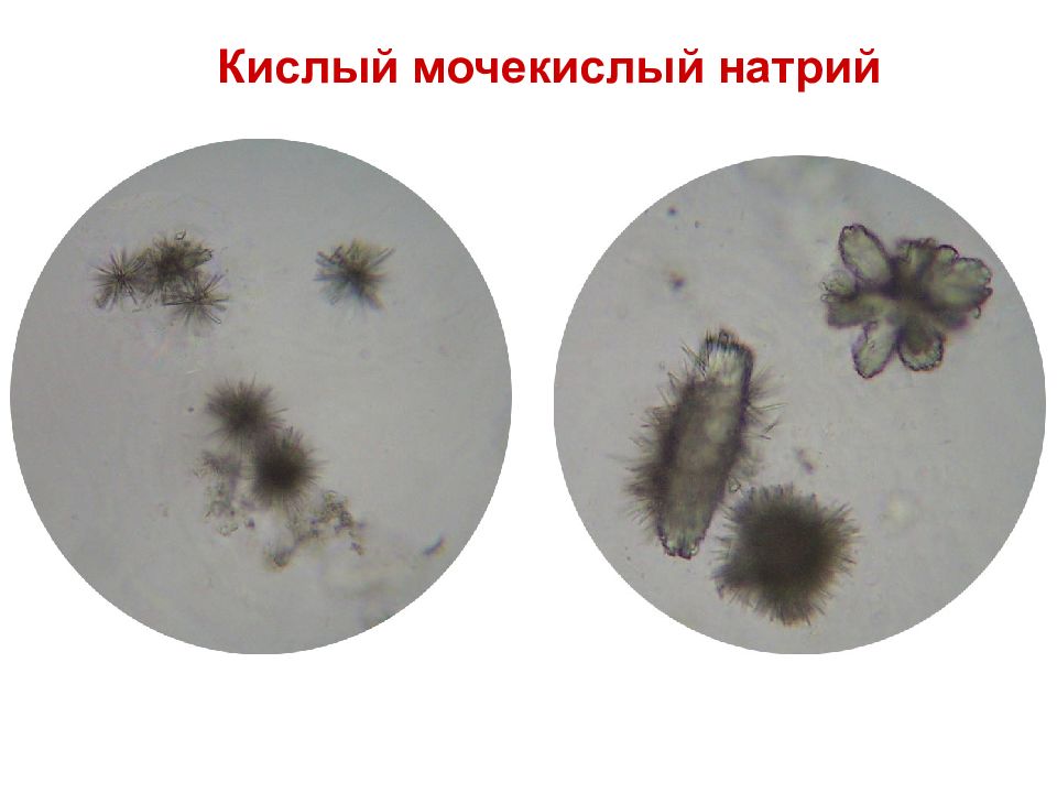 Мочекислый аммоний в моче фото под микроскопом