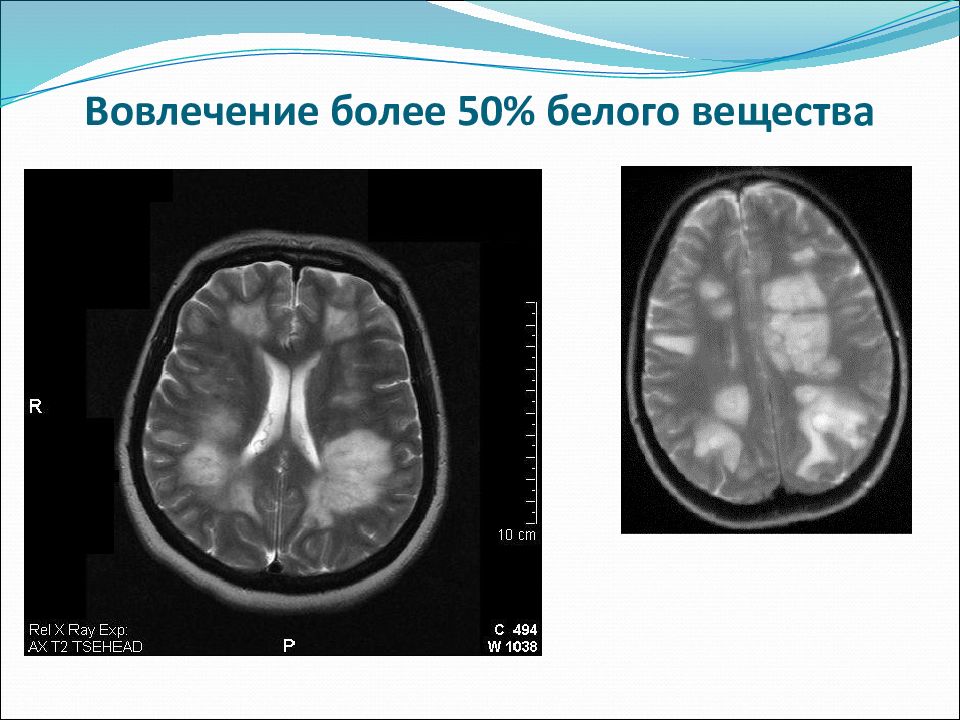 Острый рассеянный энцефаломиелит презентация