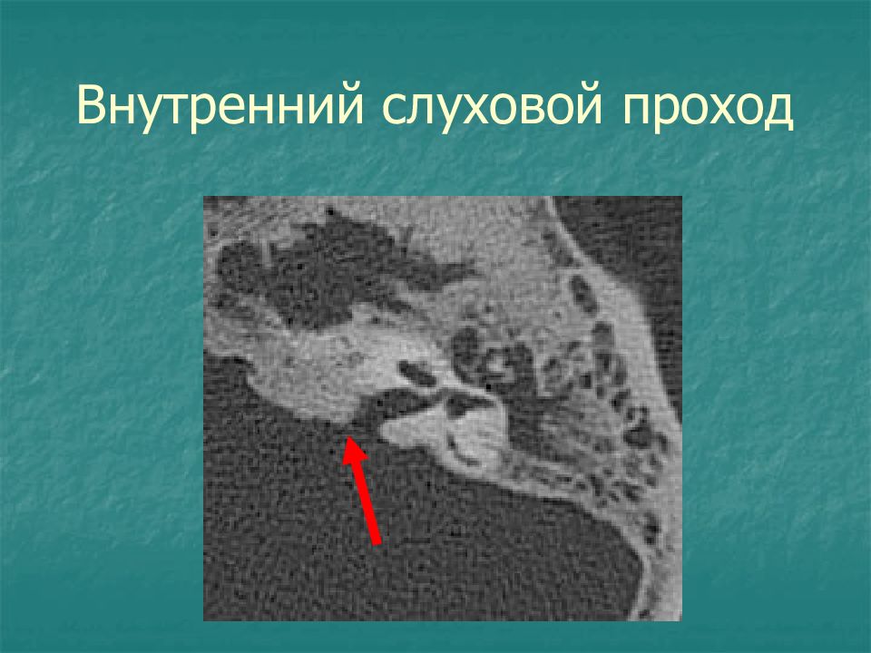 Внутренний слуховой проход. Внутреннее слуховое отверстие височной кости на кт. Внутренний слуховой проход анатомия кт. Височная кость внутренний слуховой проход. Расширение внутреннего слухового прохода кт.