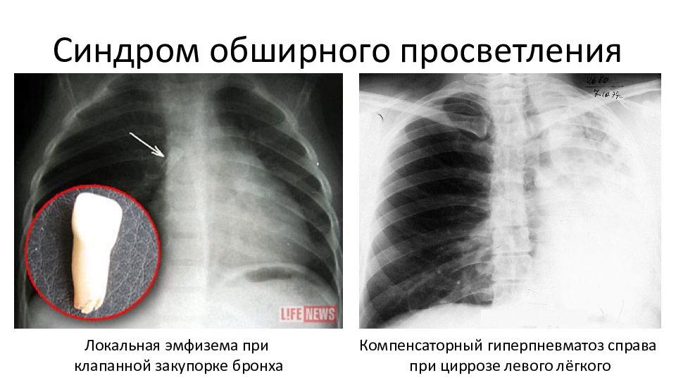 Просветление в легких. Синдром обширного просветления. Синдром обширного просветления легочного поля. Гиперпневматоз лёгких. Лучевое исследование легких.