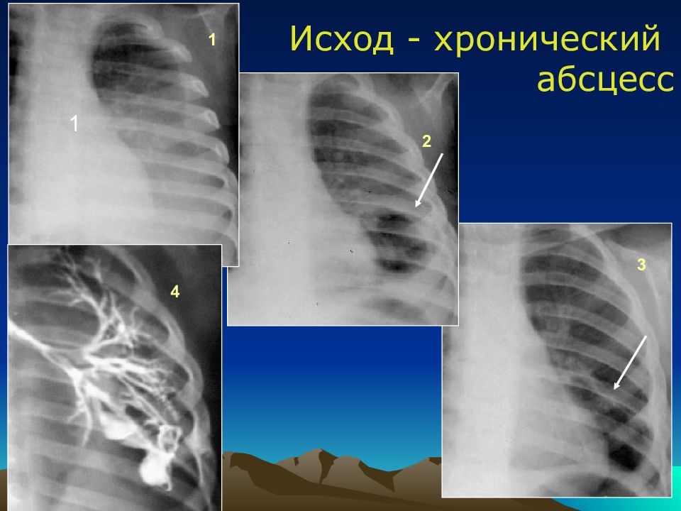 Острая гнойная деструктивная пневмония у детей презентация