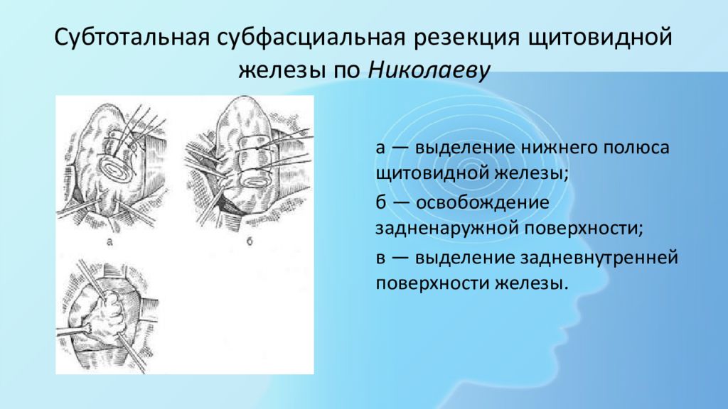 Резекция щитовидной железы