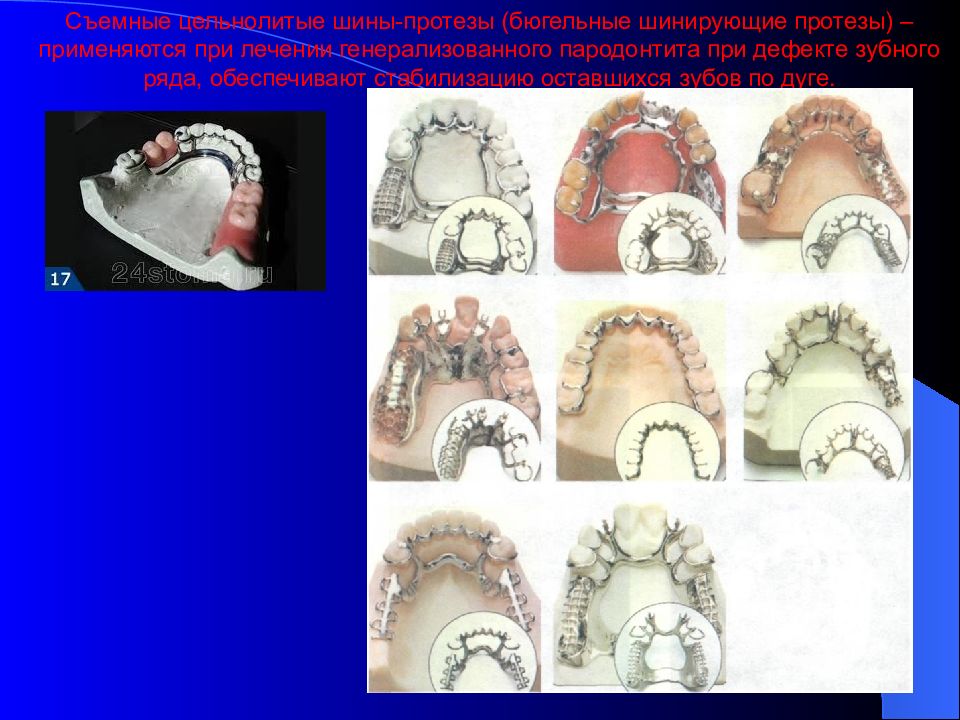 Клинико лабораторные этапы изготовления бюгельных протезов презентация