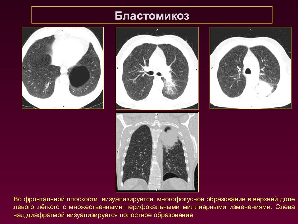 Образование в верхней доле легкого