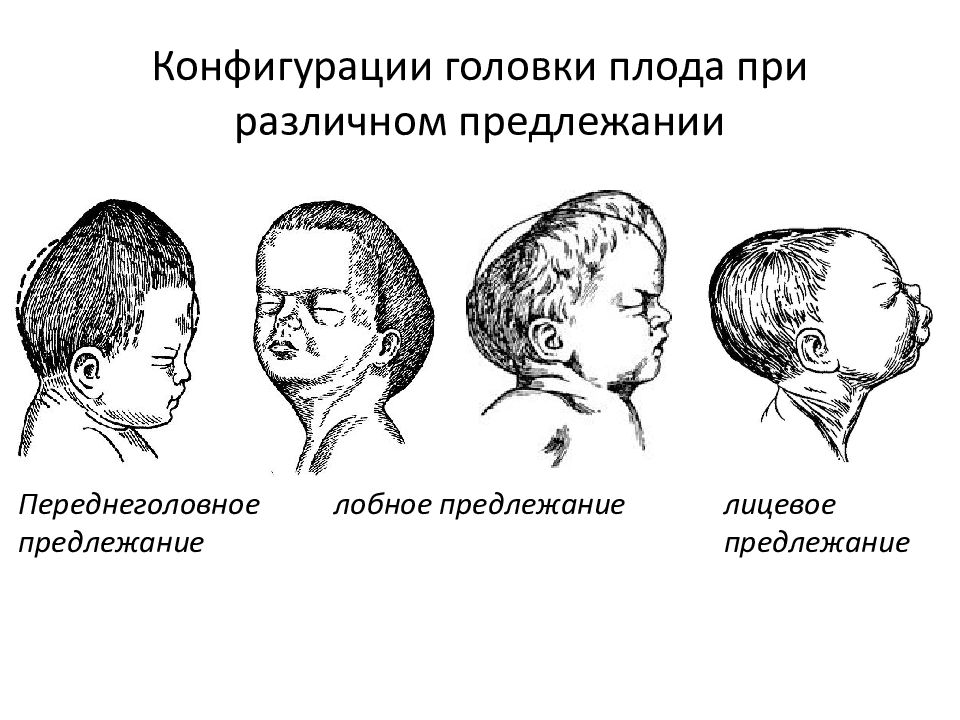 Презентация головка плода