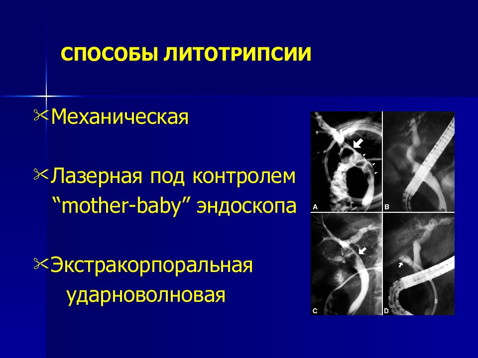 Осложнения механической желтухи. Эндобилиарная литотрипсия. Осложнения литотрипсии. Желчекаменная болезнь осложнения. Лазерная цистолитотрипсия.