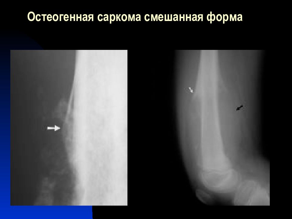 Формы остеогенной саркомы. Остеогенная саркома презентация. Остеогенная саркома локализация. Формулировка диагноза остеогенная саркома.