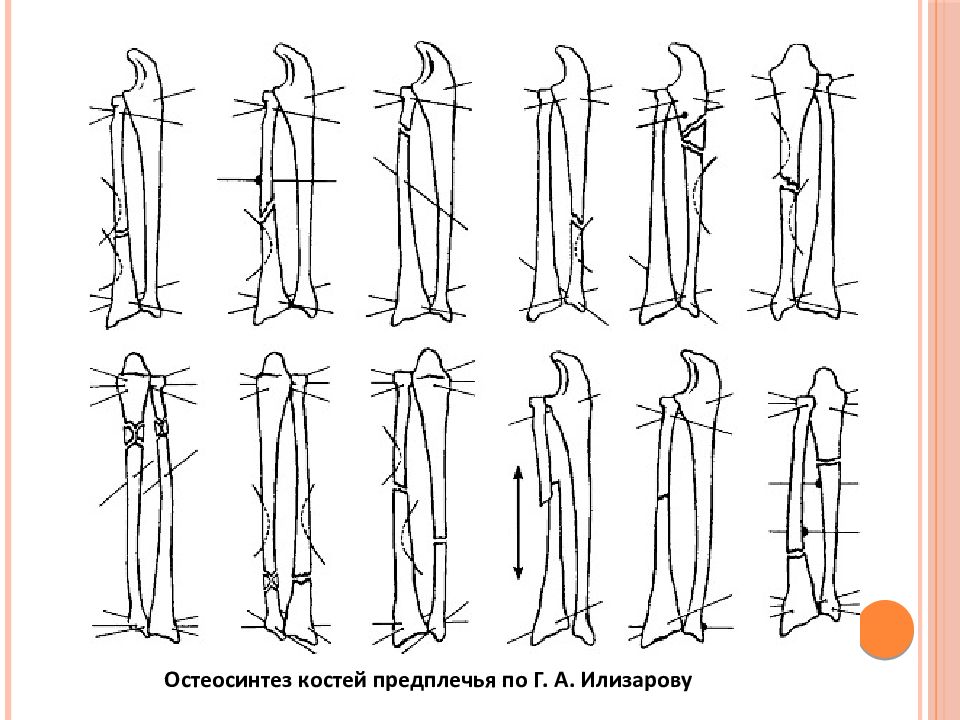 Перелом предплечья рисунок