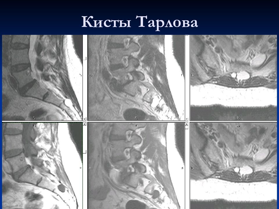 Периневральная киста. Периневральная киста позвоночника поясничного отдела s1. Периневральная киста позвоночника поясничного отдела s3 s4. S2-s3 периневральная киста. Периневральная киста s2 корешка.