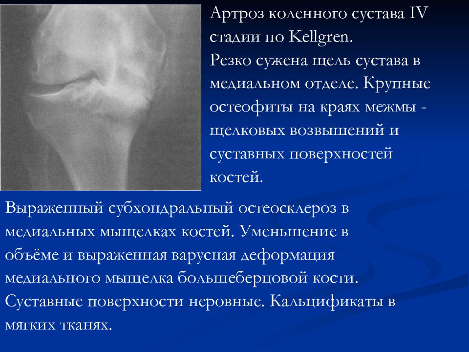 Склероз суставов. Субхондральный остеосклероз медиального мыщелка. Субхондральный склероз суставных поверхностей. Субхондральный склероз суставных поверхностей коленного сустава. Субхондральный остеосклероз суставных поверхностей стопы.