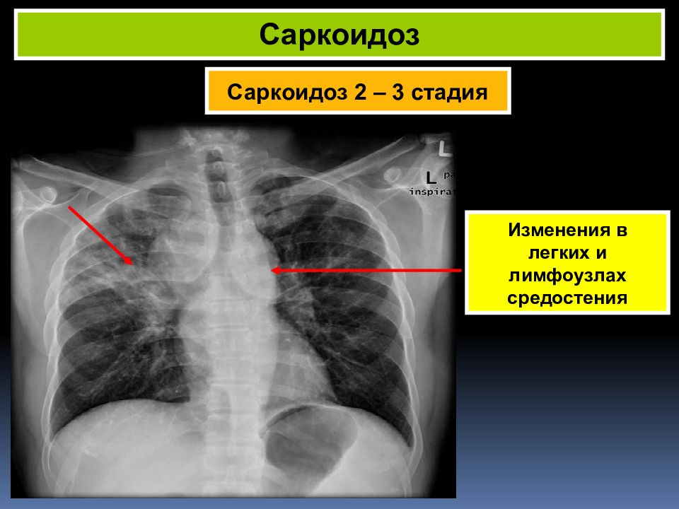 Саркоидоз легких. Саркоидоз легких 2 стадия рентген. Стадии саркоидоза легких.