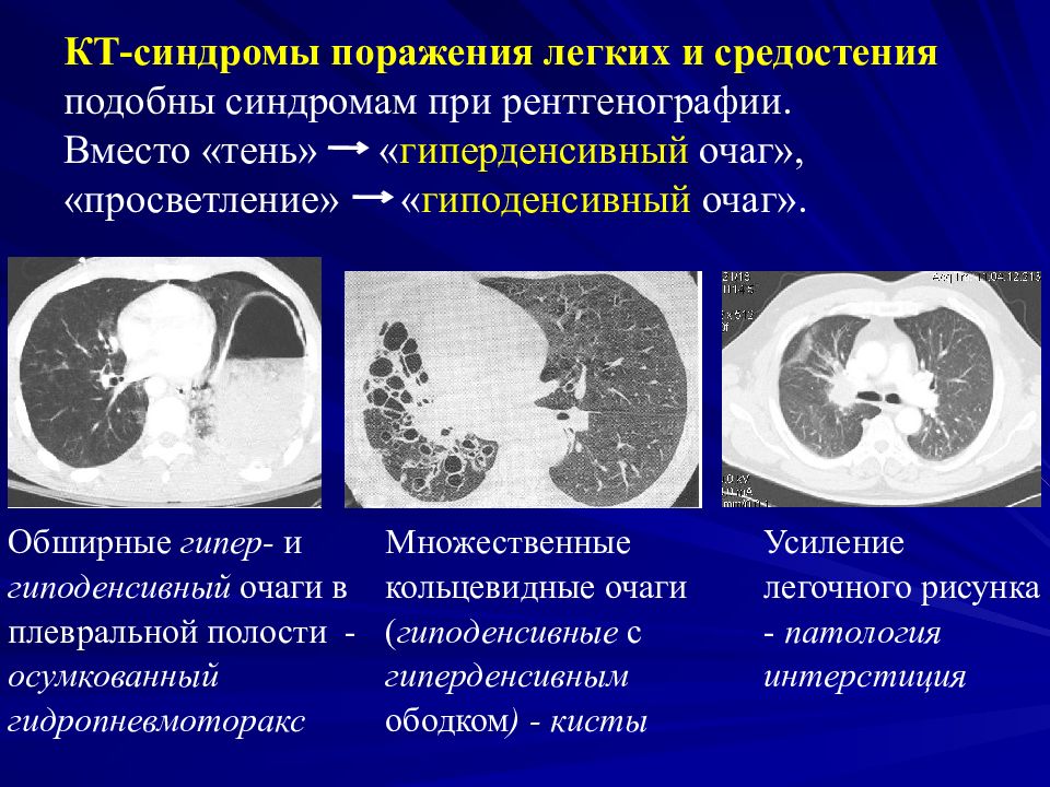 Усиление легочного рисунка на кт