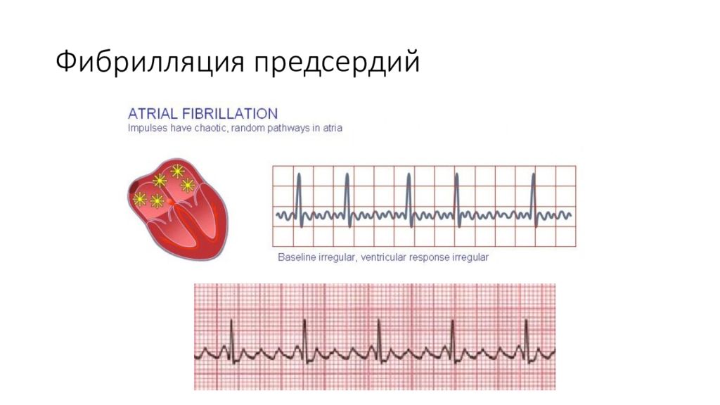 Фибрилляция предсердий что это. Фибрилляция предсердий этиология. Фибрилляция предсердий патогенез схема. Мерцательная аритмия фибрилляция предсердий. Фибрилляция предсердий эктопический очаг.