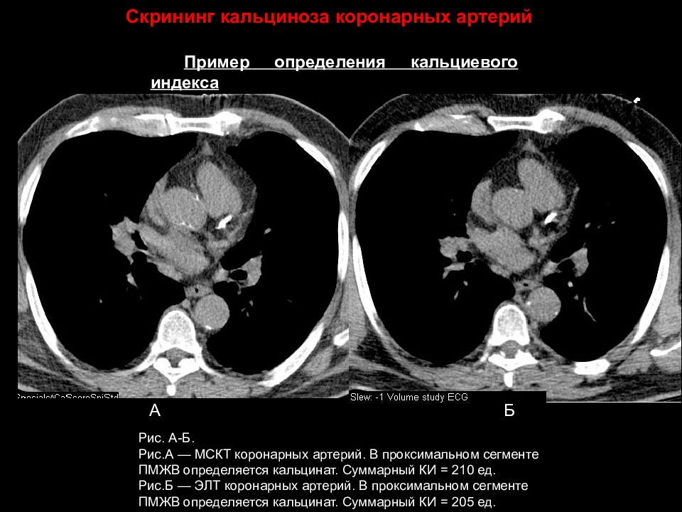 Кт скрининг коронарного кальция