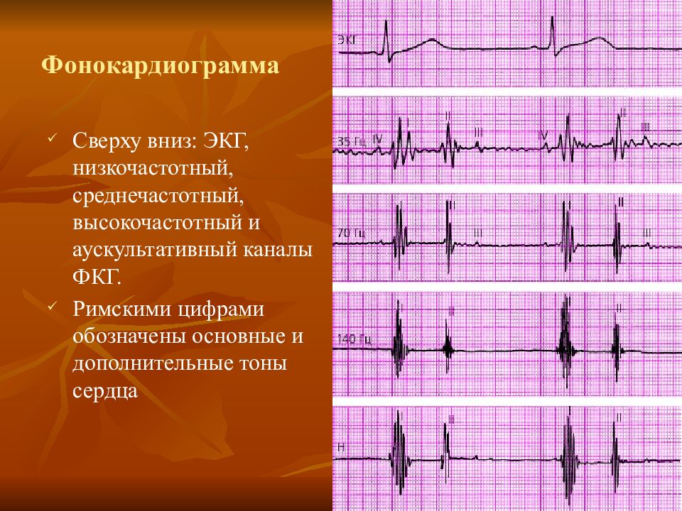 Графическое изображение тонов сердца