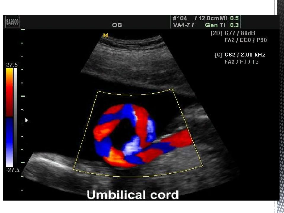 Допплерометрия. Венозный проток УЗИ допплер. Допплерография венозного протока у плода. Дуплексное сканирование сердца и сосудов плода. Допплерометрия фото.