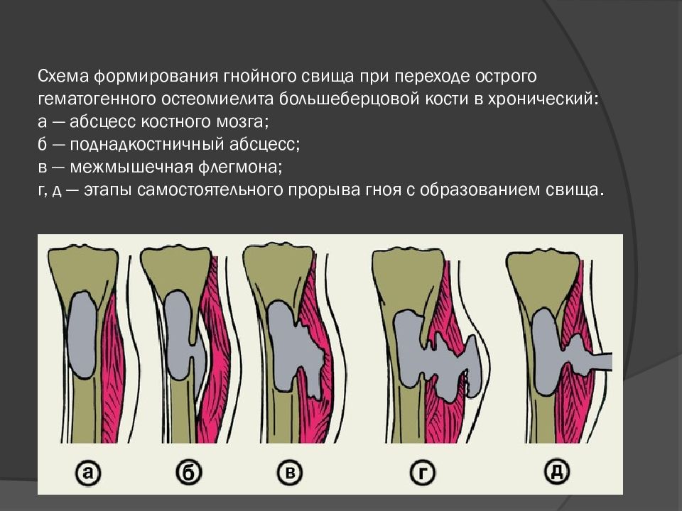 Развитие острого остеомиелита. Схема развития острого гематогенного остеомиелита. Острый гематогенный остеомиелит. Острая фаза гематогенного остеомиелита схема. Острый остеомиелит большеберцовой кости.