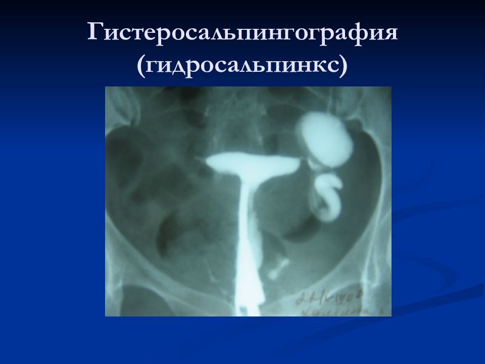Гсг. Гидросальпинкс ГСГ рентген. Гидросальпинкс рентген. Метросальпингс рентген.