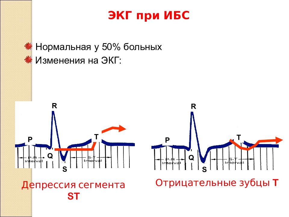 Ишемия боковой стенки на экг