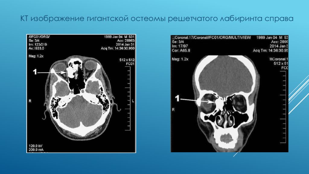 Рак полости носа и придаточных пазух презентация