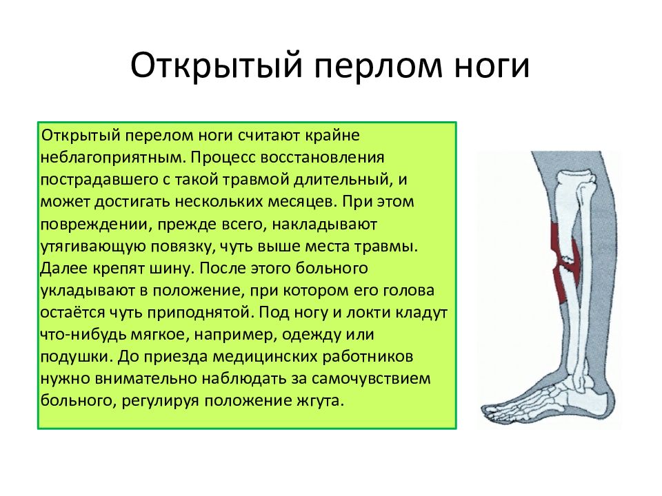 Переломы голени презентация