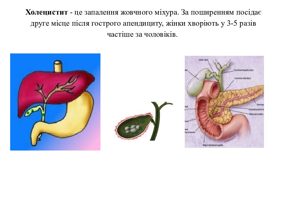 Холецистит симптомы и лечение. Презентация на тему холецистит. Острый и хронический холецистит. Холецистит жалобы пациента.