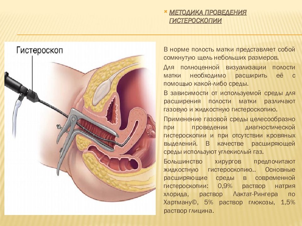 Гистероскопия матки презентация