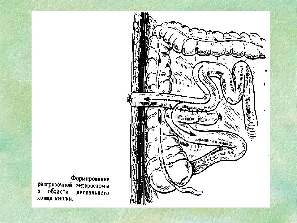 Тонкокишечный свищ. Желудочно-ободочный кишечный свищ.