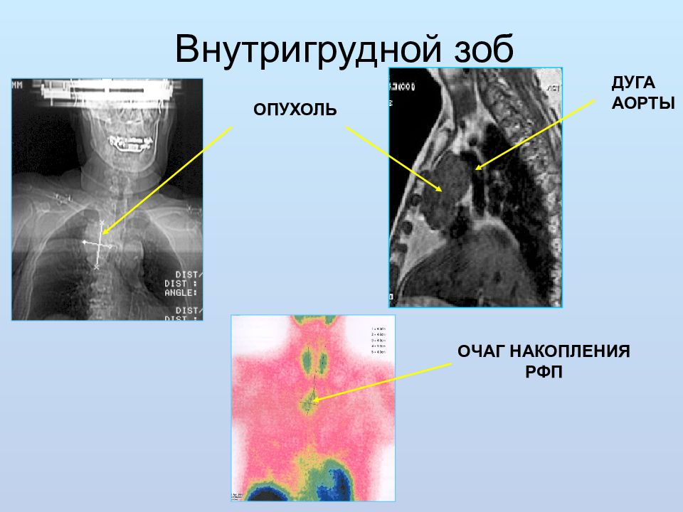 Пищевод зоб. Загрудинный зоб щитовидной железы рентген. Внутригрудной и загрудинный зоб.