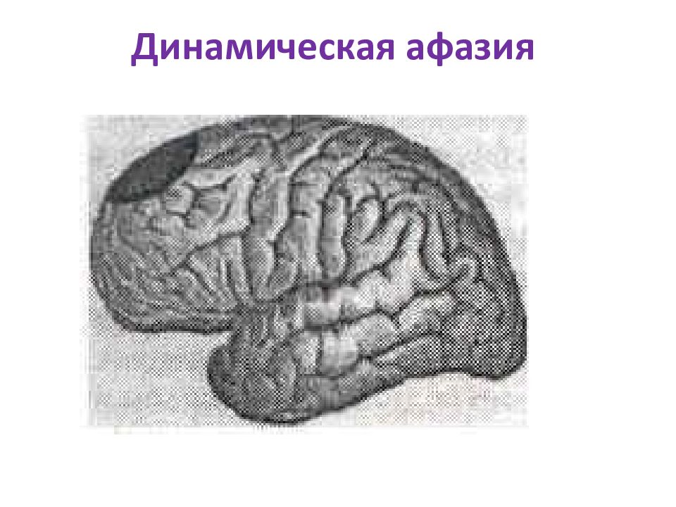 Динамическая афазия. Динамическая моторная афазия. Динамическая моторная афазия симптомы. Локализация поражения при динамической афазии. Очаг поражения при динамической афазии.