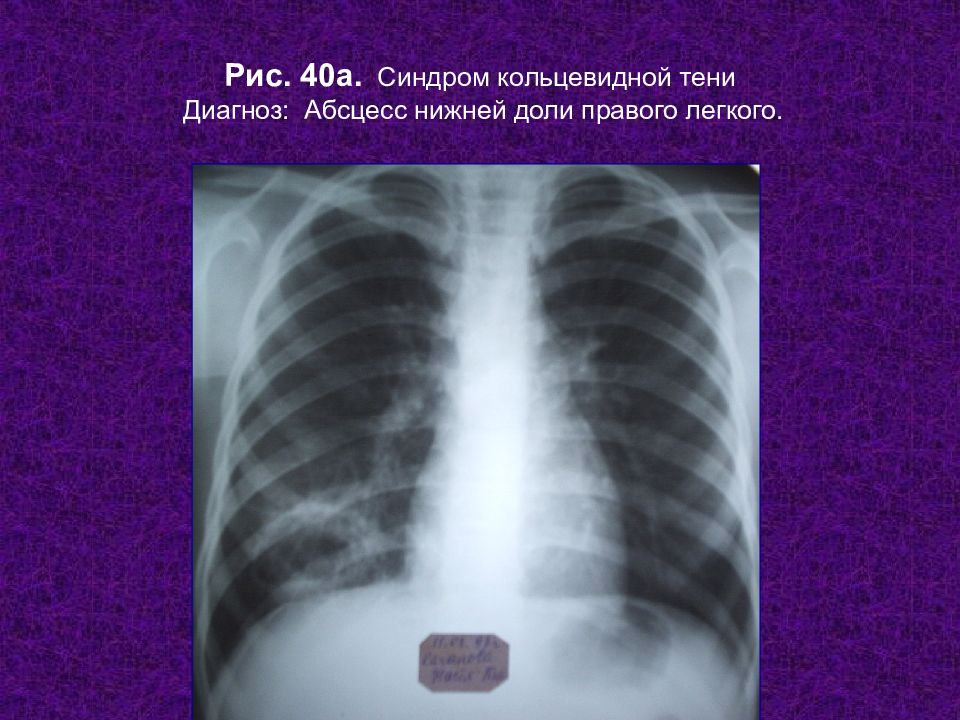 Тень в легких. Рентгенологический синдром кольцевидной тени. Абсцесс нижней доли легкого. Кольцевидная тень в легком рентген. Кольцевидные тени в легких.