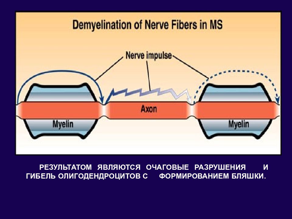 Демиелинизирующие заболевания презентация