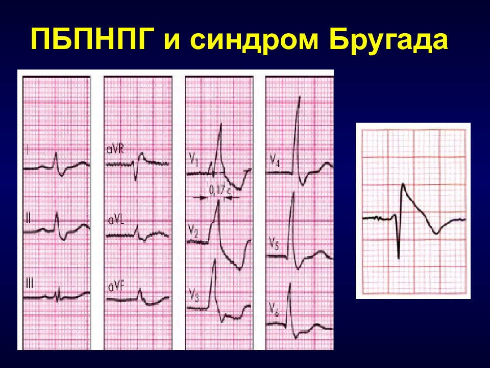 Нбпнпг. ПБПНПГ. Синдром Бругада. ЭКГ при каналопатиях. Феномен Бругада на ЭКГ.