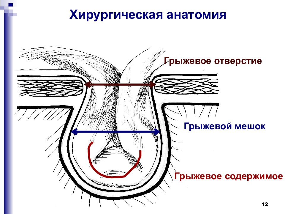 Косая и прямая паховая грыжа отличие. Косая паховая грыжа анатомия. Ущемленная косая паховая грыжа. Паховая грыжа схема строения.