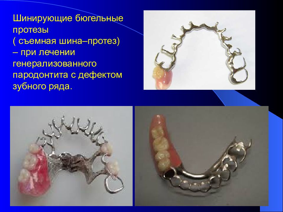 Презентация на тему бюгельный протез