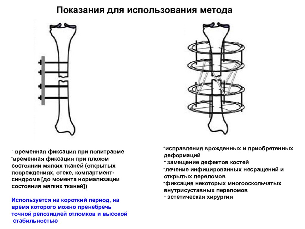 Аппарат илизарова презентация