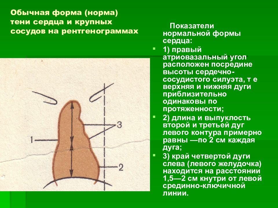 Тени сердца. Контуры сердца на рентгенограмме. Тень сердца на рентгенограмме. Дуги сердца на рентгенограмме. Правый атриовазальный угол.