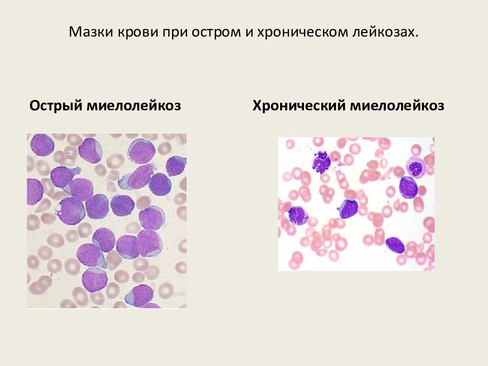 Картина крови при миелобластном лейкозе остром