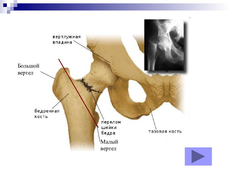 Вертел тазобедренного сустава картинка