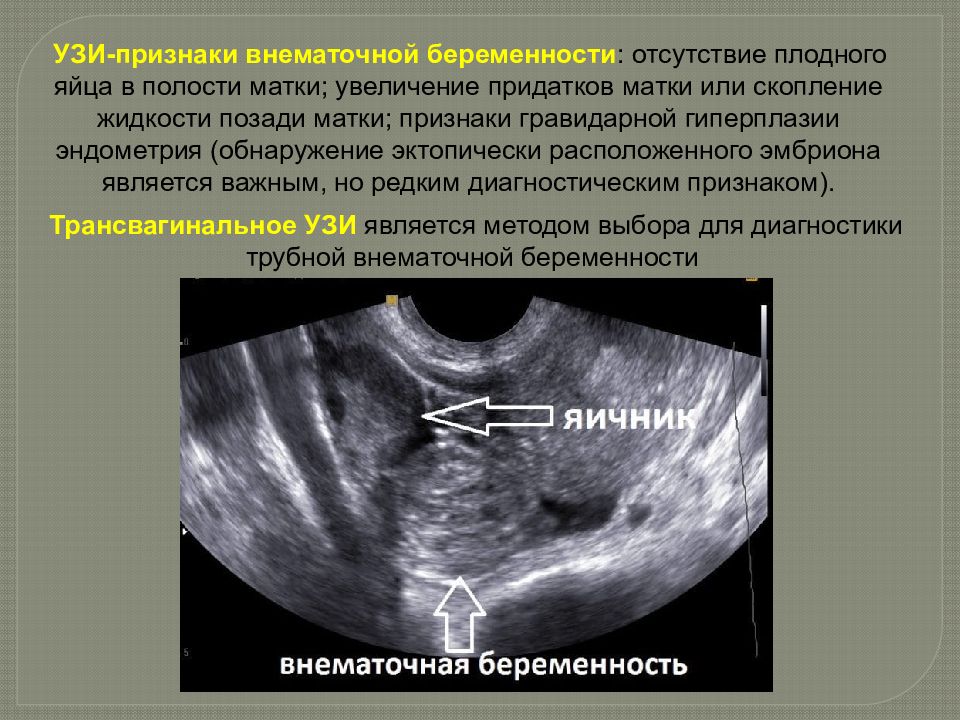 Клиническая картина внематочной беременности