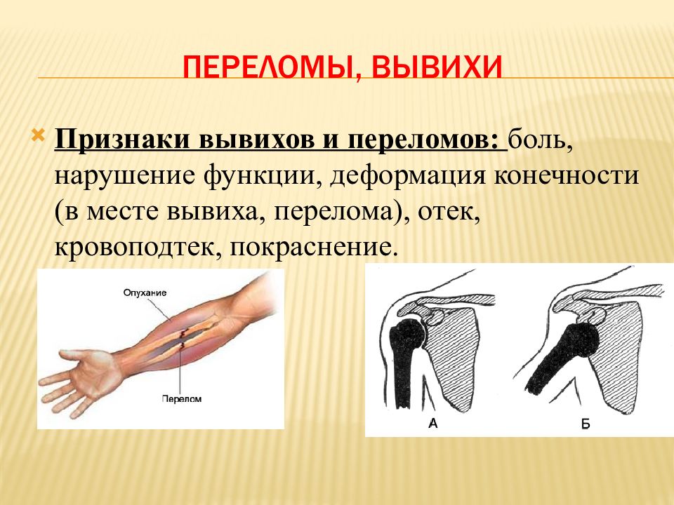 Признаками вывиха являются ответ. Что является признаком вывиха?.