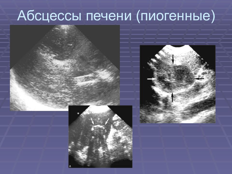 Абсцесс печени узи картина