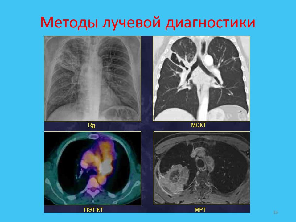 Лучевая диагностика рака легкого презентация