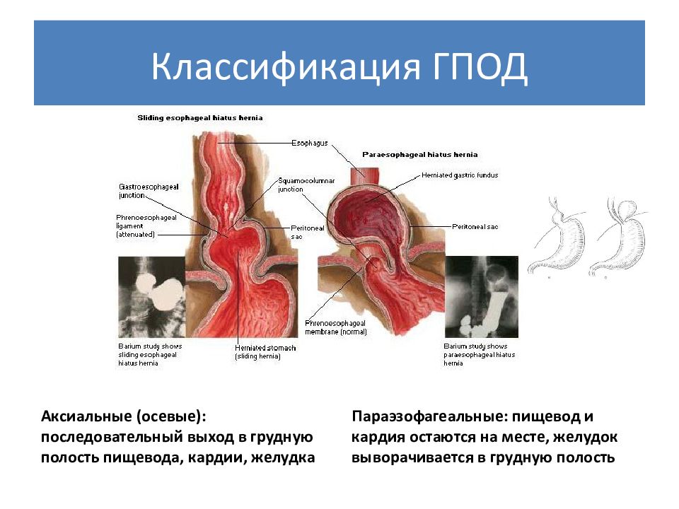 Схема лечения грыжи пищеводного отверстия диафрагмы