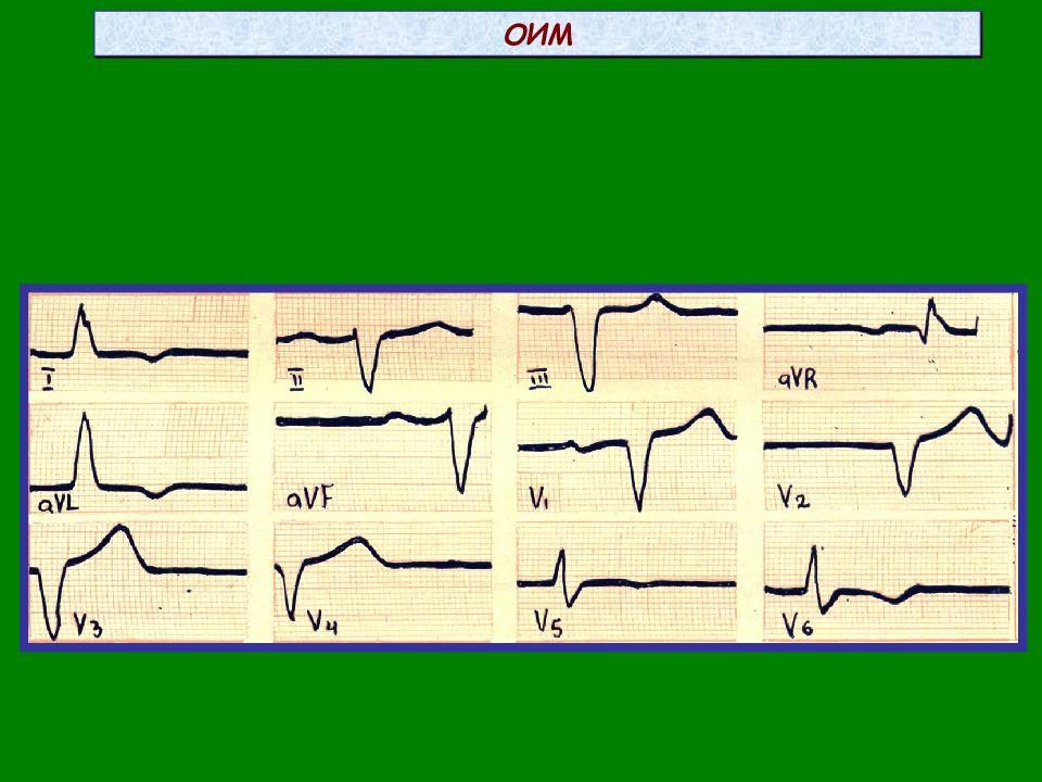Оим. Высокий r в правых прекордиальных отведениях. ОИМ начало начало. ОИМ локалис.