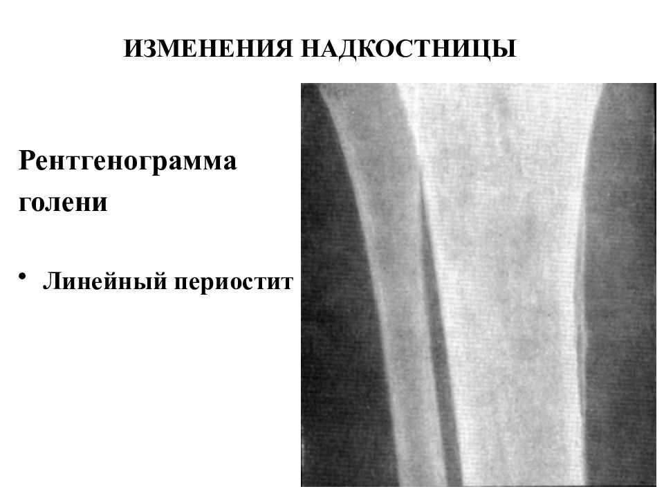 Периостит голени. Оссифицирующий периостит рентген. Периостит голени рентгенограмма. Периостит большеберцовой кости на рентгене. Оссифицирующие периоститы.