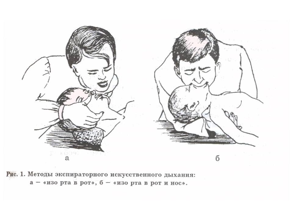 Неотложные состояния у детей педиатрия. Неотложные состояния у детей картинки. Искусственное дыхание изо рта в нос. Неотложка в педиатрии.