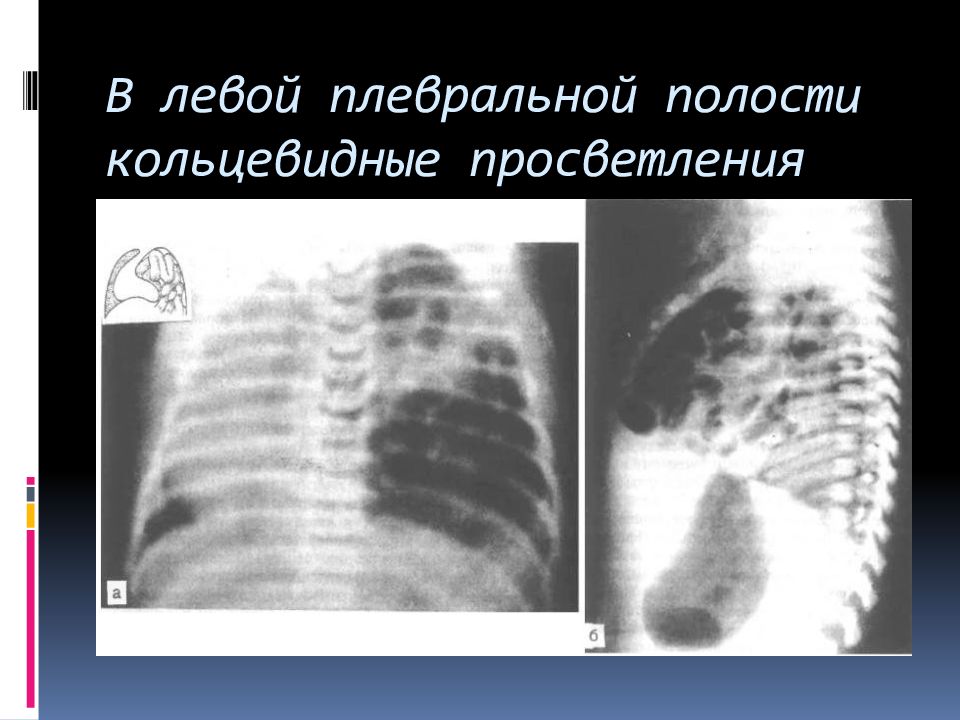 Диафрагмальная грыжа презентация хирургия