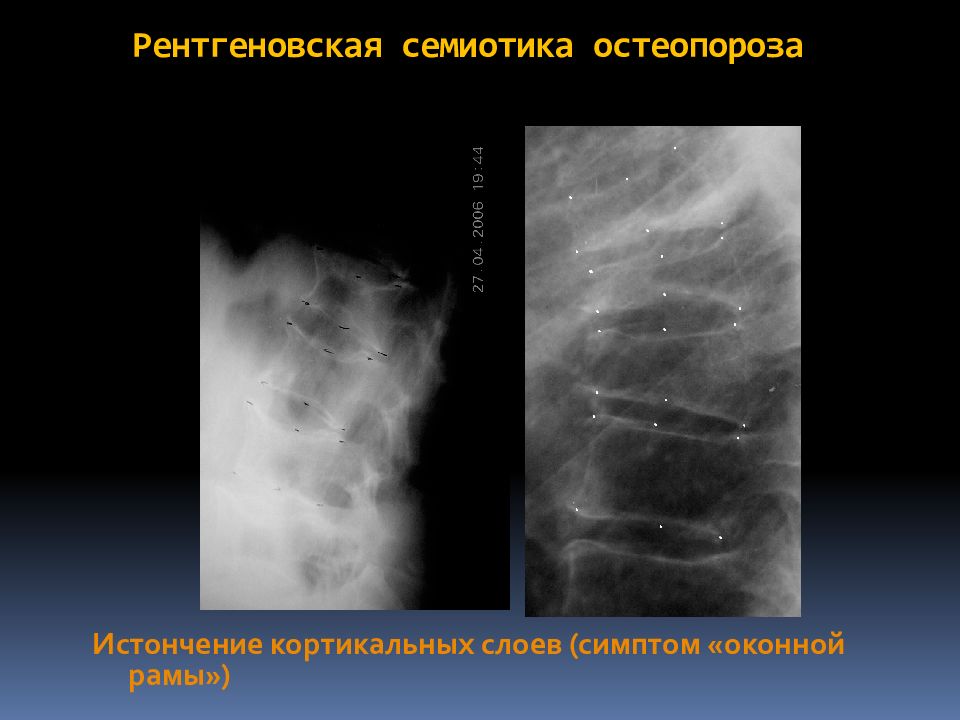 Складки пищевода. Остеопороз рентген признаки. Рентген при остеопорозе. Кортикальный остеопороз это. Симптом оконной рамы.